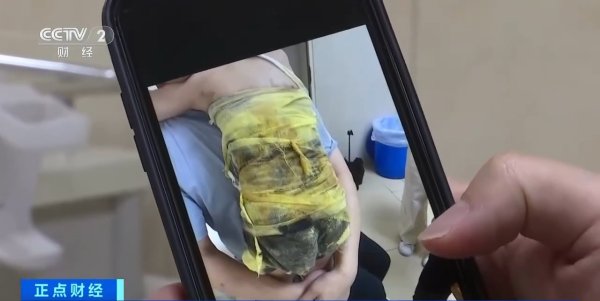 散户配资 夏季高发儿童烫伤 处理不当或致严重感染
